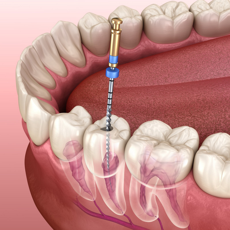درمان آبسه دندان با عصب‌کشی