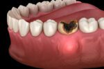 آبسه دندان چیست و بعد از چند روز خوب می‌ شود؟