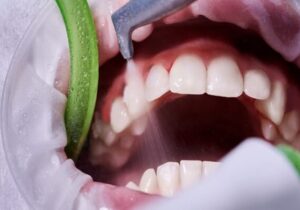 جرم‌گیری، راهی موثر برای پیشگیری از پوسیدگی و بیماری لثه