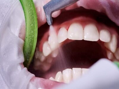 جرم‌گیری، راهی موثر برای پیشگیری از پوسیدگی و بیماری لثه